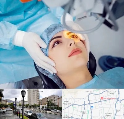 دکتر عمل لیزیک چشم در شمال غرب تهران