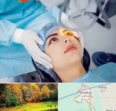 دکتر عمل لیزیک چشم در کردکوی