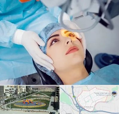 دکتر عمل لیزیک چشم در مرزداران تبریز
