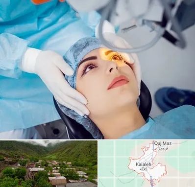 دکتر عمل لیزیک چشم در کلاله