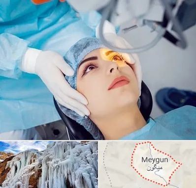 دکتر عمل لیزیک چشم در میگون