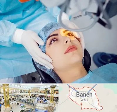دکتر عمل لیزیک چشم در بانه
