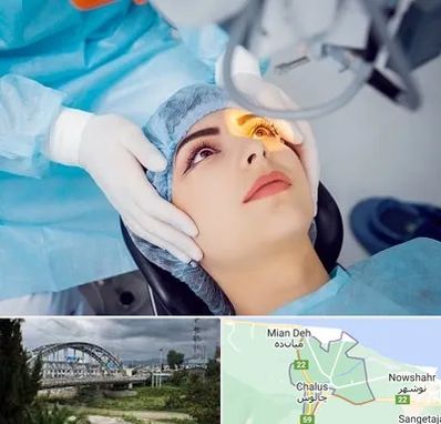 دکتر عمل لیزیک چشم در چالوس