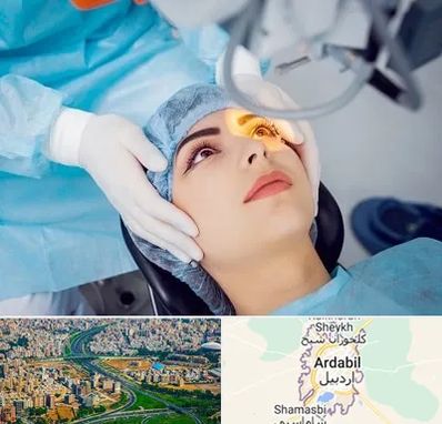 دکتر عمل لیزیک چشم در اردبیل