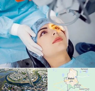 دکتر عمل لیزیک چشم در بابل