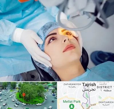 دکتر عمل لیزیک چشم در تجریش
