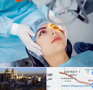 دکتر عمل لیزیک چشم در فرمانیه