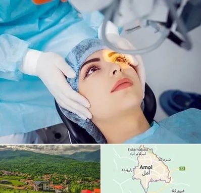 دکتر عمل لیزیک چشم در آمل