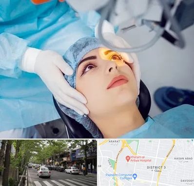 دکتر عمل لیزیک چشم در ظفر