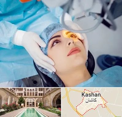 دکتر عمل لیزیک چشم در کاشان