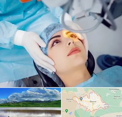 دکتر عمل لیزیک چشم در مرند
