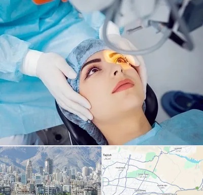 دکتر عمل لیزیک چشم در شمال شرق تهران