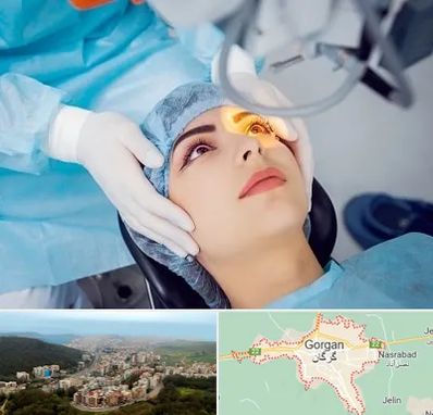 دکتر عمل لیزیک چشم در گرگان