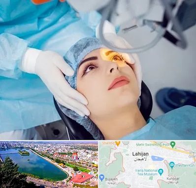 دکتر عمل لیزیک چشم در لاهیجان