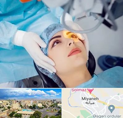 دکتر عمل لیزیک چشم در میانه