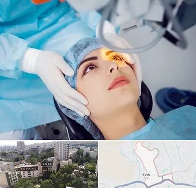 دکتر عمل لیزیک چشم در اوین