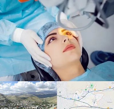 دکتر عمل لیزیک چشم در رودهن