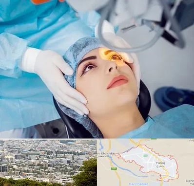 دکتر عمل لیزیک چشم در یاسوج