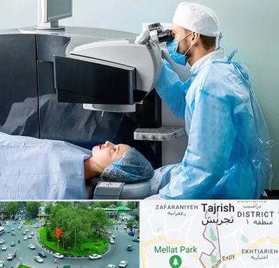 مرکز لیزیک چشم در تجریش