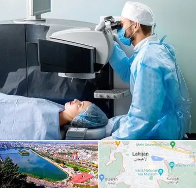 مرکز لیزیک چشم در لاهیجان