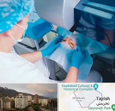 دکتر عمل لازک چشم در زعفرانیه