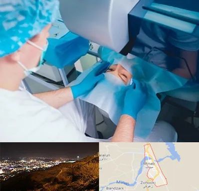 دکتر عمل لازک چشم در میناب