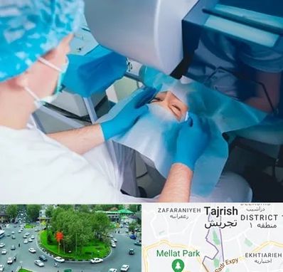 دکتر عمل لازک چشم در تجریش