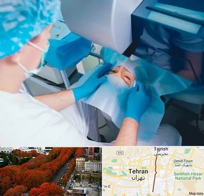 دکتر عمل لازک چشم در ولیعصر