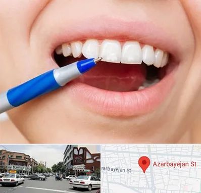 دندانسازی ارزان در خیابان آذربایجان