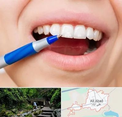 دندانسازی ارزان در علی آباد کتول