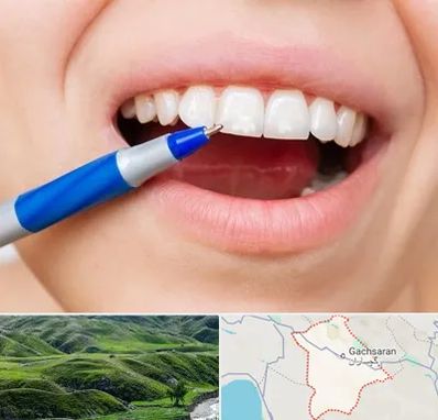 دندانسازی ارزان در گچساران