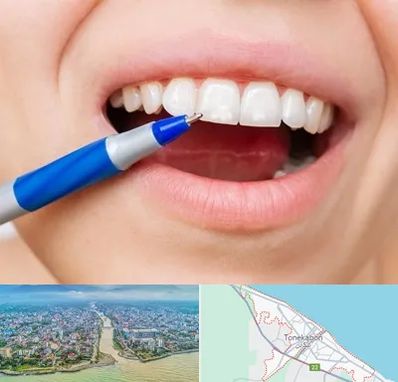 دندانسازی ارزان در تنکابن