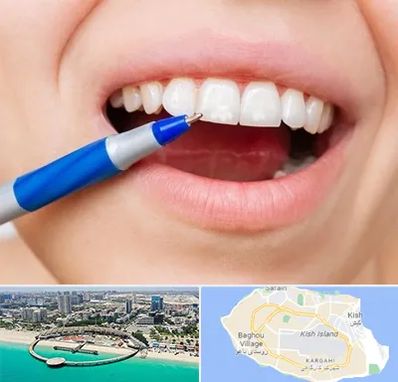 دندانسازی ارزان در کیش