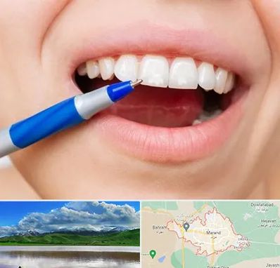 دندانسازی ارزان در مرند