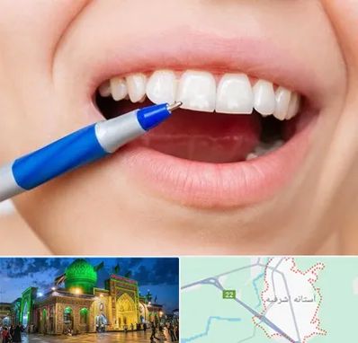 دندانسازی ارزان در آستانه اشرفیه