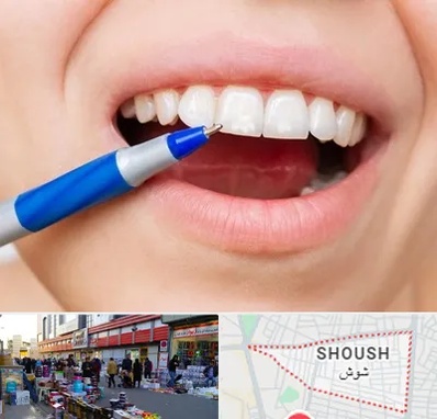 دندانسازی ارزان در شوش
