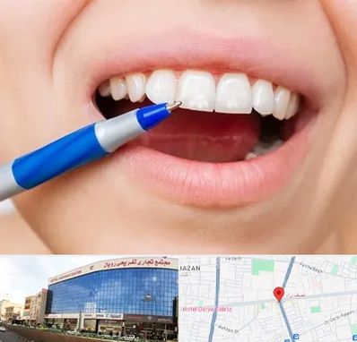 دندانسازی ارزان در نصف راه تبریز