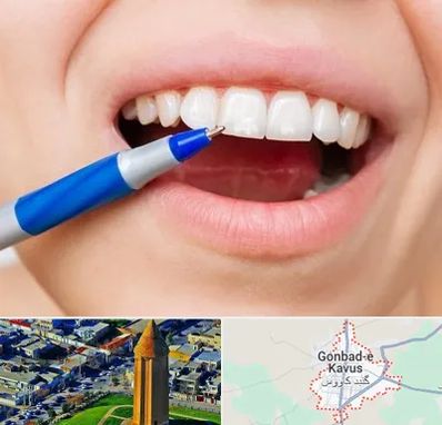 دندانسازی ارزان در گنبد کاووس