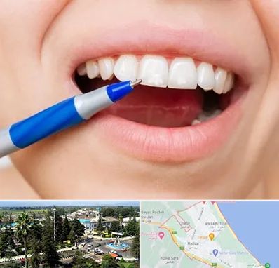 دندانسازی ارزان در رودسر