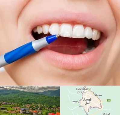 دندانسازی ارزان در آمل