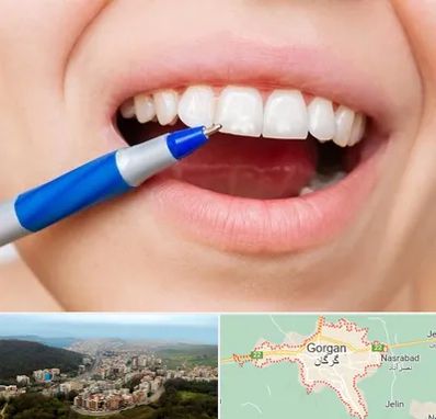 دندانسازی ارزان در گرگان