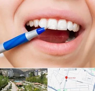 دندانسازی ارزان در بلوار تعاون