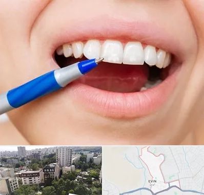 دندانسازی ارزان در اوین