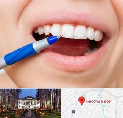 دندانسازی ارزان در باغ فردوس