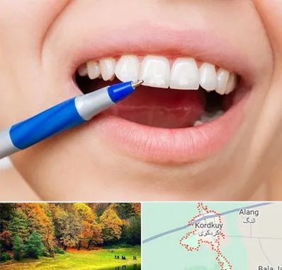 دندانسازی ارزان در کردکوی