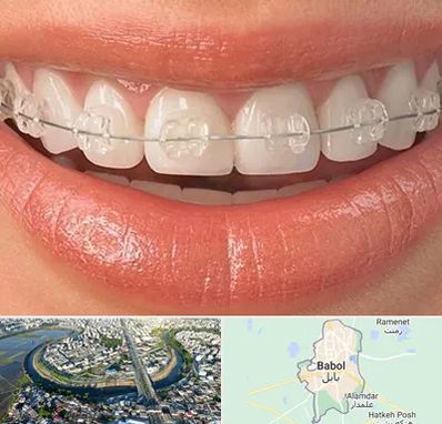 ارتودنسی اقساطی در بابل