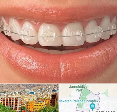 ارتودنسی اقساطی در نیاوران 