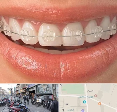 ارتودنسی اقساطی در چهارراه استانبول
