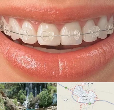 ارتودنسی اقساطی در شیروان