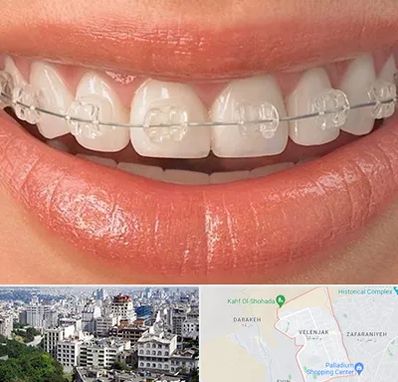 ارتودنسی اقساطی در ولنجک 